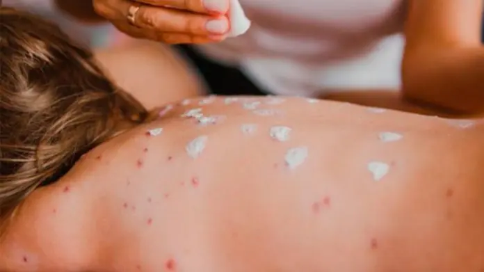Nuevo aviso epidemiológico por Sarampión en México